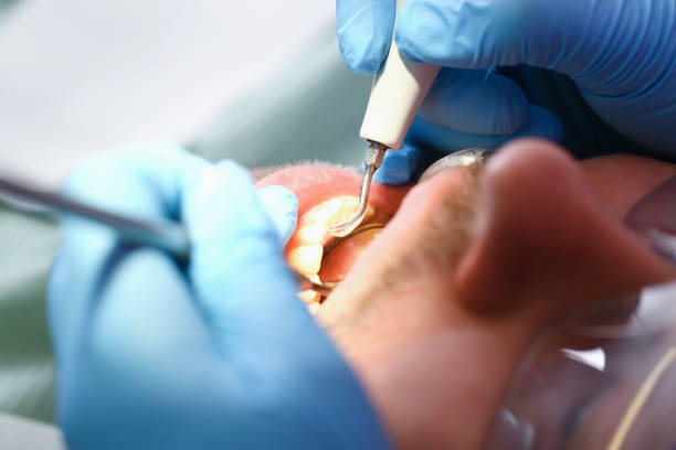 Best Emergency Dentist for Knocked-Out Tooth in Mill City, OR